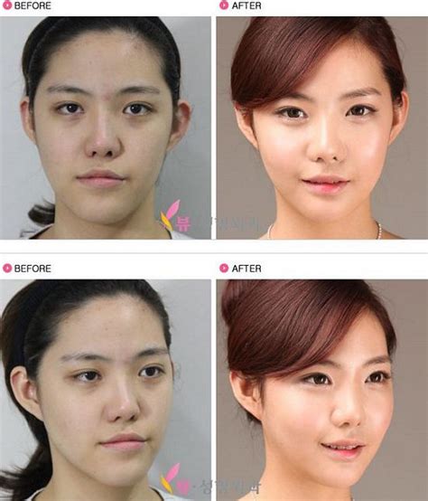 lv plastic surgery|lv plastic surgery korea.